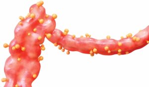 diverticulitis, divertículos, inflamación, infección, síntomas, causas, tratamiento, prevención | gedyt gastroenterología análisis y terapéutica
